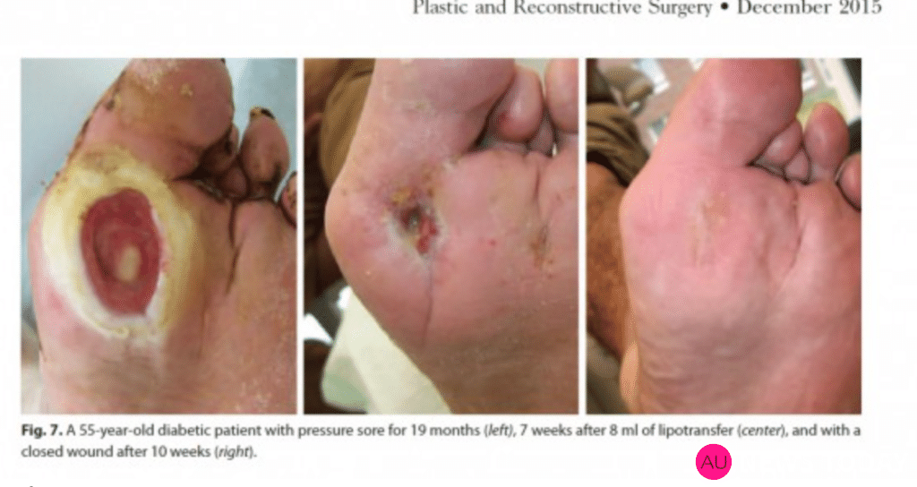 Débridement and Autologous Lipotransfer (fat grafting, lipofilling) for Chronic Ulceration of the Diabetic Foot and Lower Limb Improves Wound Healing reconstructive surgery
 