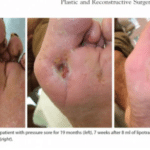 Débridement and Autologous Lipotransfer (fat grafting, lipofilling) for Chronic Ulceration of the Diabetic Foot and Lower Limb Improves Wound Healing reconstructive surgery