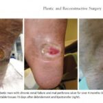 Débridement and Autologous Lipotransfer (fat grafting, lipofilling) for Chronic Ulceration of the Diabetic Foot and Lower Limb Improves Wound Healing reconstructive surgery