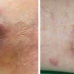 Débridement and Autologous Lipotransfer (fat grafting, lipofilling) for Chronic Ulceration of the Diabetic Foot and Lower Limb Improves Wound Healing reconstructive surgery